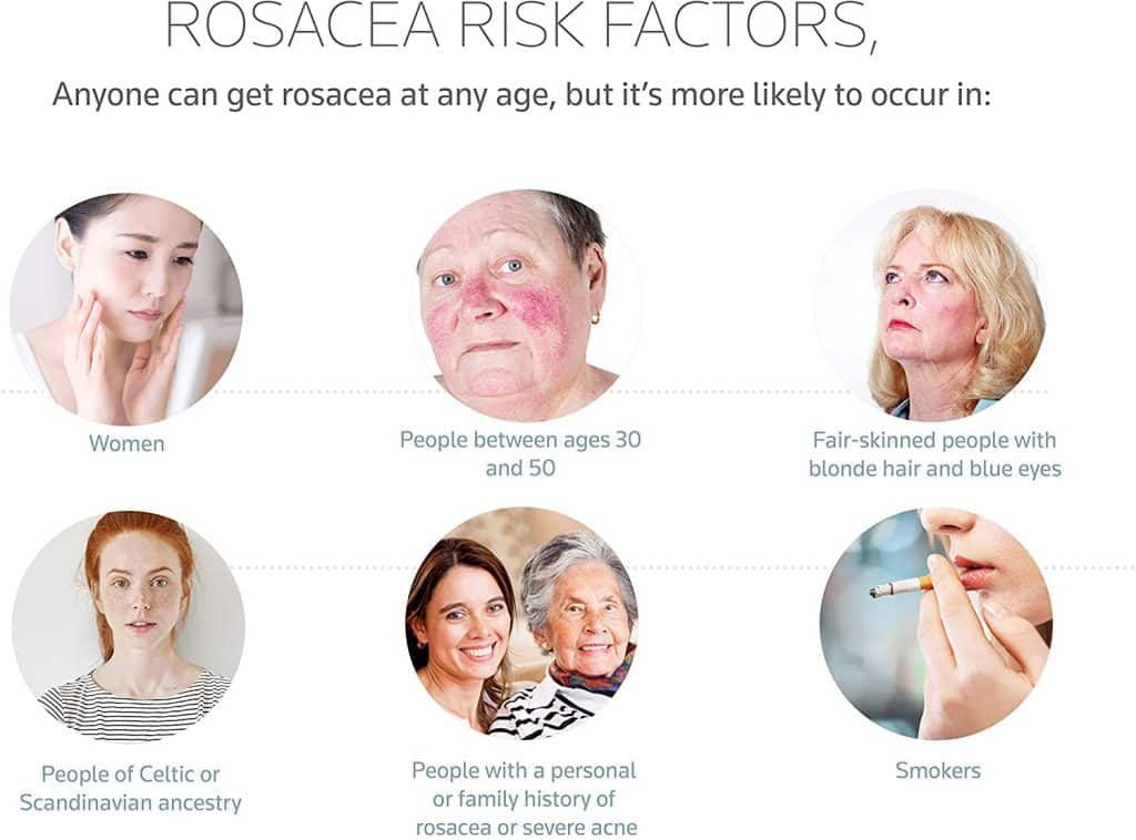 Prosacea Rosacea Gel Results