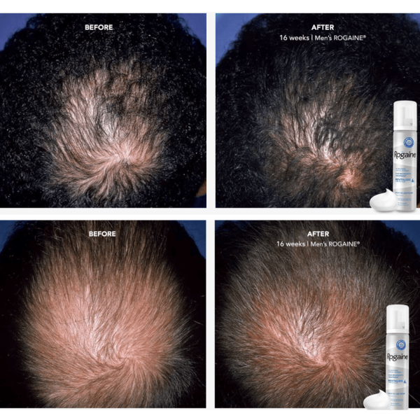 Does Rogaine (Minoxidil 5%) Work For Male Pattern Baldness