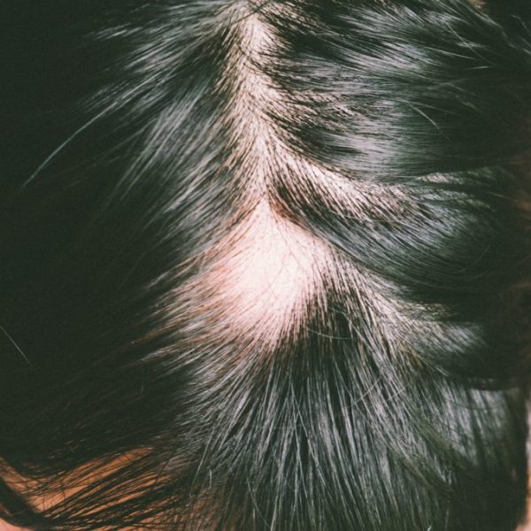 What is alopecia