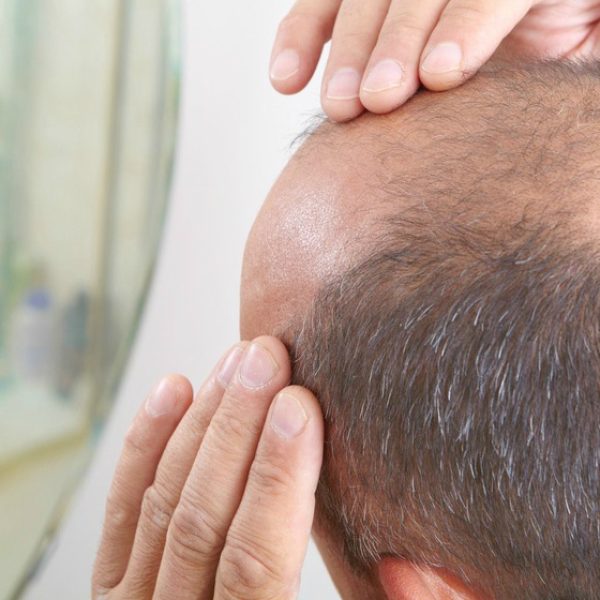 middleaged-man-concerned-hair-loss-baldness-stem-cell-treatment-for-hair-loss-ss-FEATURE-