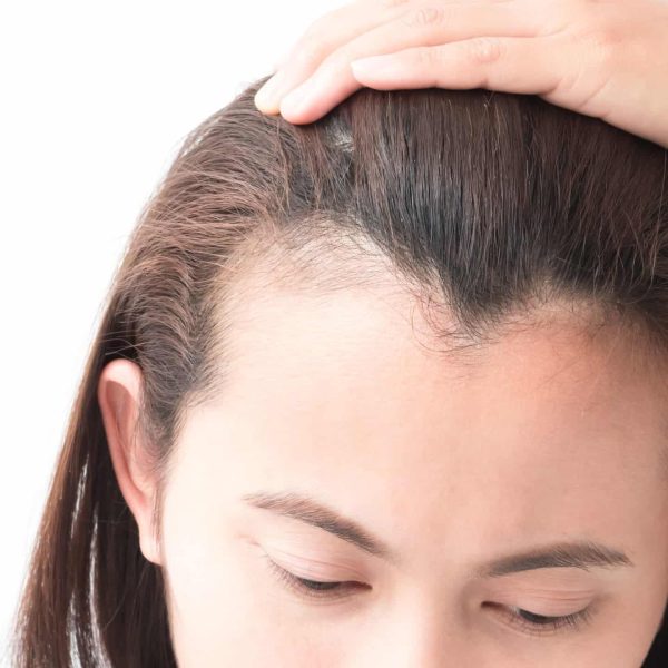 receding-hairline-lede