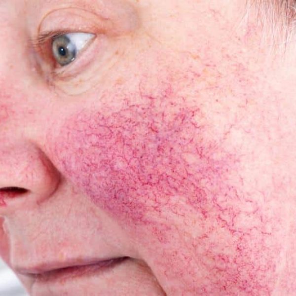 rosacea treatment